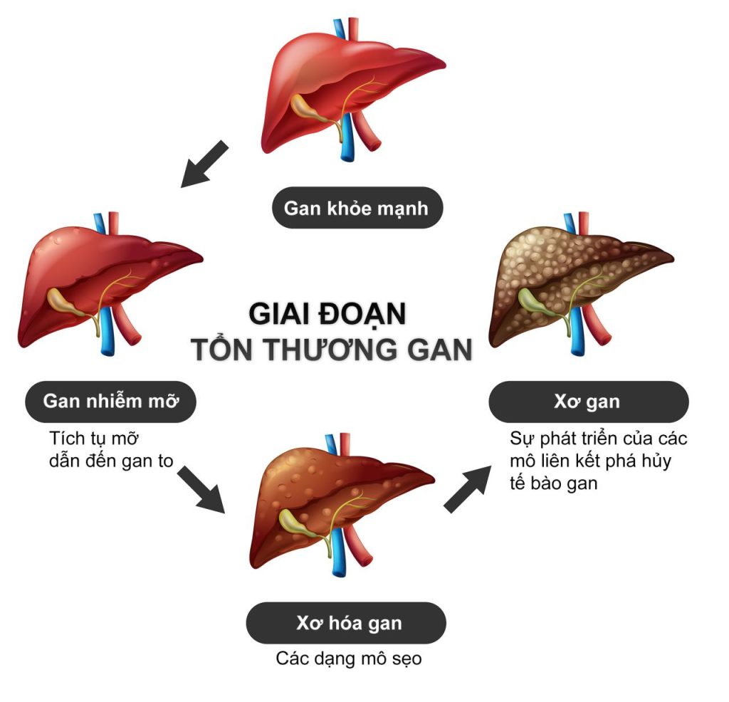 Viêm Gan B